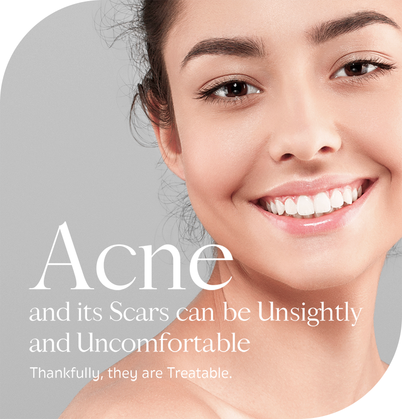 Acne & Acne Scars