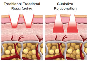 eMatrix™ Sublative Rejuvenation