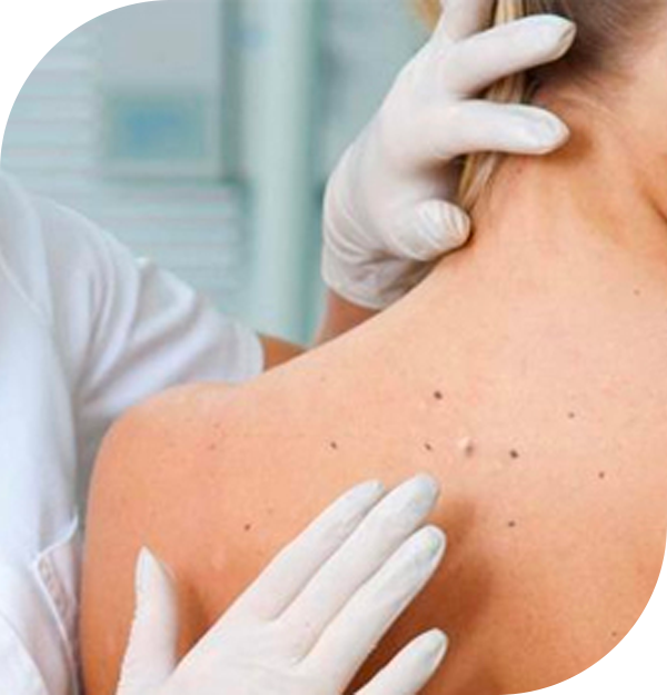 Skin Cancer Screening