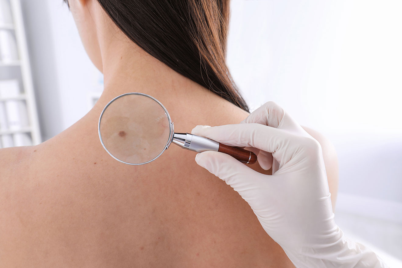 A dermatologist examining a patient’s mole