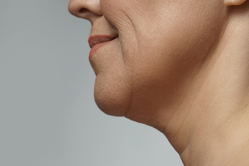 Close-up of a female patient with sagging skin considering Ultherapy.