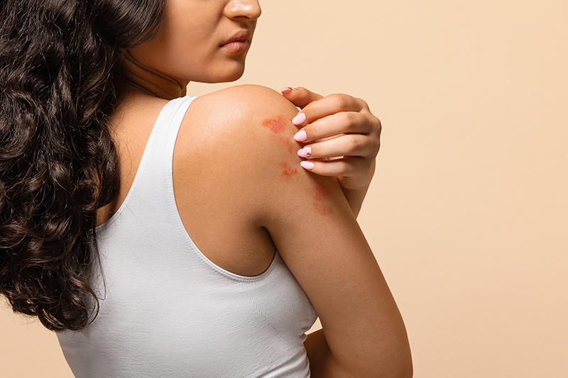 A woman with a medical dermatological condition.